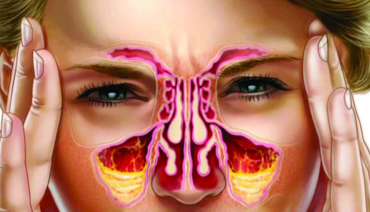 Suffering From Sinus? Here’s How To Keep It At Bay…